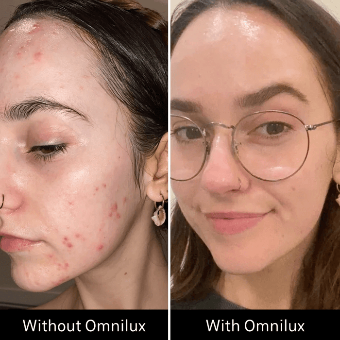 Omnilux Clear (Acne) LED Mask